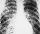 Four clinical signs can improve GP pneumonia diagnosis, finds study