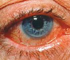 Acute red eye – Key questions (1.5 CPD hours)