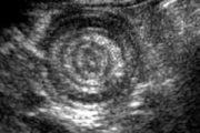 Paediatric clinic – Intussusception