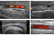 Non-Covid clinical crises: Temporal (giant cell) arteritis