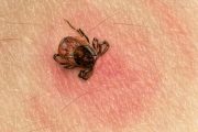 NICE: GPs ‘should consider’ antibiotics for Lyme disease without test result