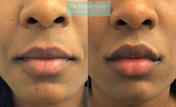 Dermal Filler - Lips - 002BA