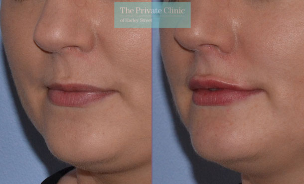 Dermal Filler - Lips - 005MR