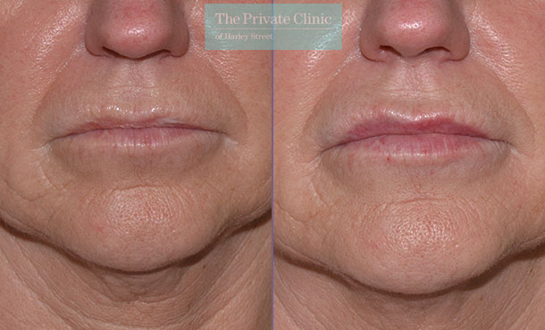 Dermal Filler - Lips - 007MR