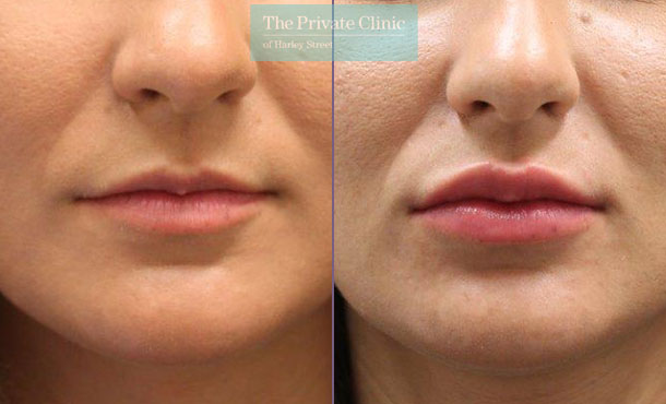 Dermal Filler - Lips - 004SC