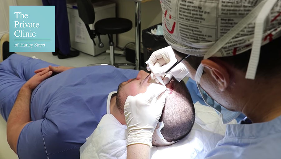 micro-fue-hair-transplant-implanter