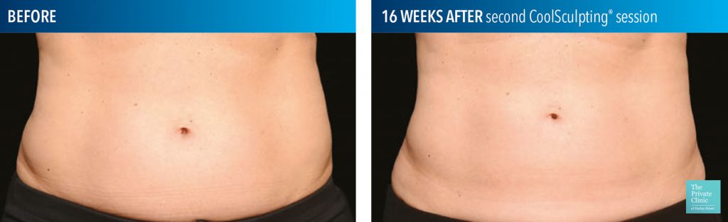 coolsculpting for the tummy before after photo