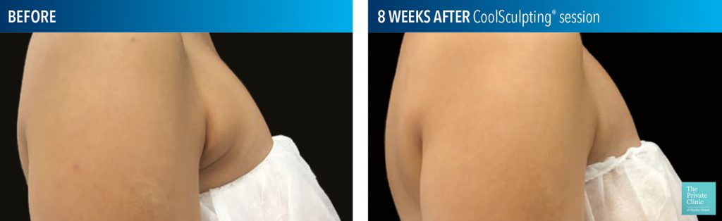 CoolSculpting for bra fat before after photo