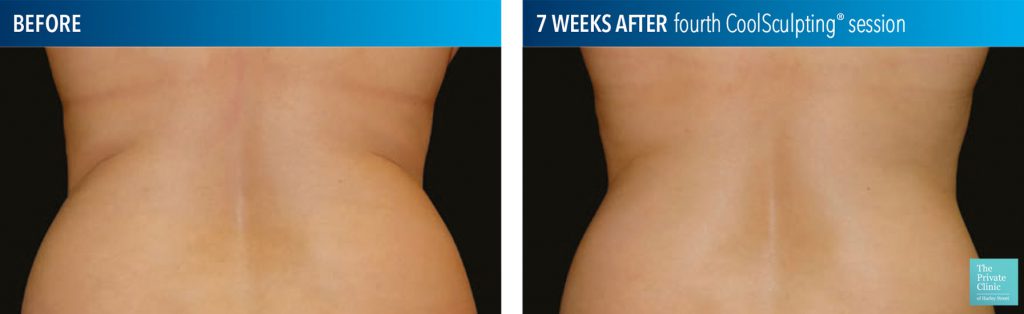 coolSculpting for flanks before after photo