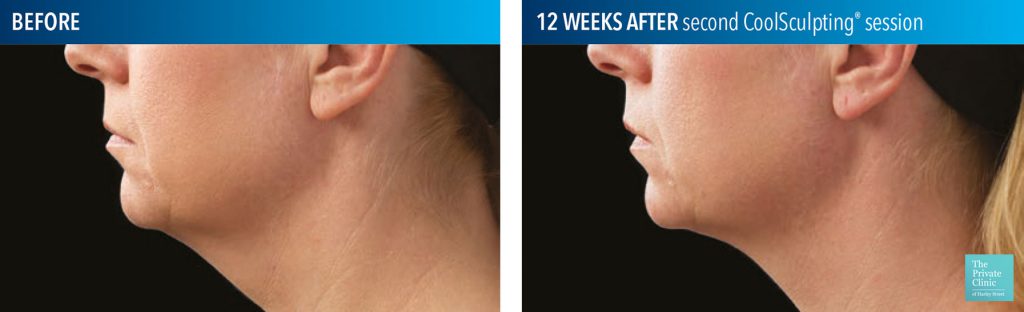 coolsculpting chin before after photos