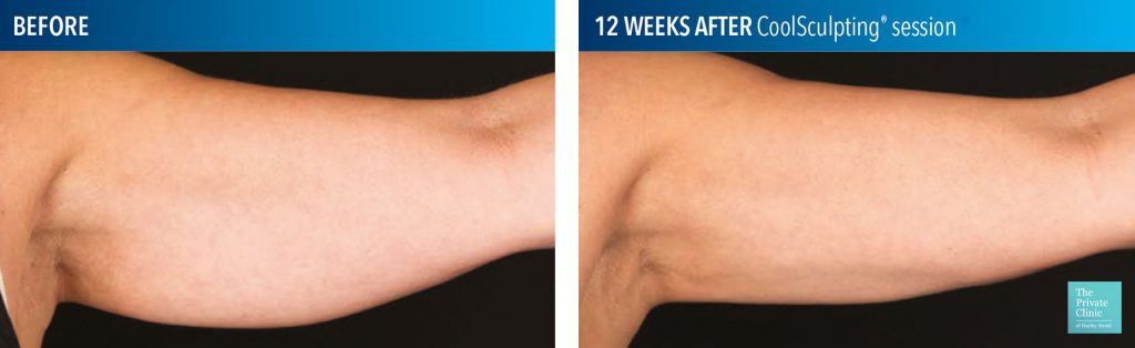 CoolSculpting for the upper arms before after photo